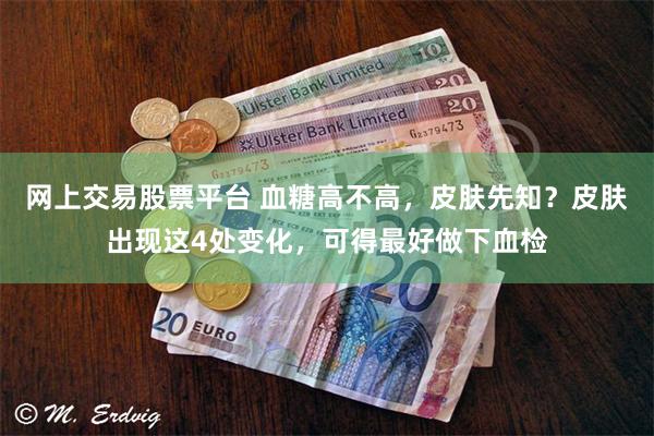 网上交易股票平台 血糖高不高，皮肤先知？皮肤出现这4处变化，可得最好做下血检